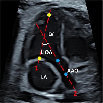 Left ventricle inflow and outflow tract angle in normal fetuses